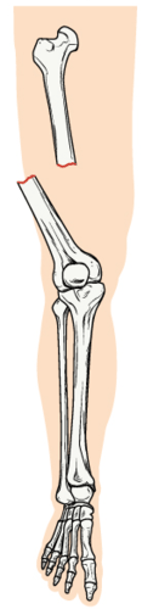 <p>Compound fracture; broken bone with an open wound</p>