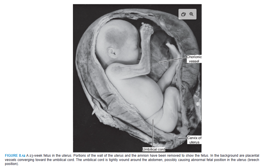 <p> STRUCTURE OF THE PLACENTA</p><p>By the beginning of the fourth month, the placenta has two components: (1) a fetal portion, formed by the chorion frondosum, and (2) a maternal portion, formed by the decidua basalis (Fig. 8.10B). On the fetal side, the placenta is bordered by the chorionic plate (Fig. 8.13); on its maternal side, it is bordered by the decidua basalis, of which the decidual plate is most intimately incorporated into the placenta. In the junctional zone, trophoblast and decidual cells intermingle. This zone, characterized by decidual and syncytial giant cells, is rich in amorphous extracellular material. By this time, most cytotrophoblast cells have degenerated. Between the chorionic and decidual plates are the intervillous spaces, which are filled with maternal blood. They are derived from lacunae in the syncytiotrophoblast and are lined with syncytium of fetal origin. The villous trees grow into the intervillous blood lakes (Figs. 8.8 and 8.13). </p>