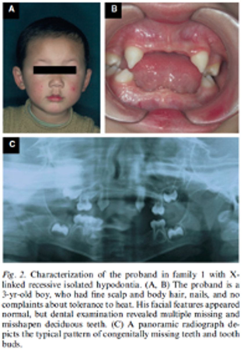 <p>Hypohidrotic ectodermal dysplasia and hypodontia has what pattern of inheritance?</p>