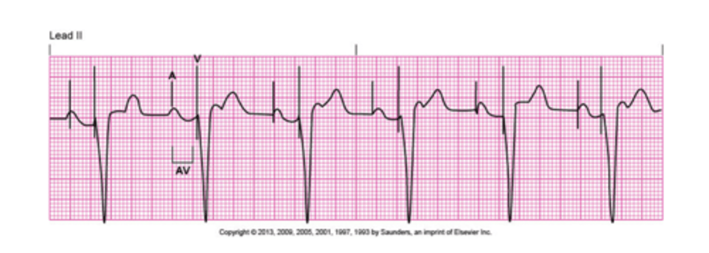 <p>Combination of both atrial and ventricular pacing.</p>