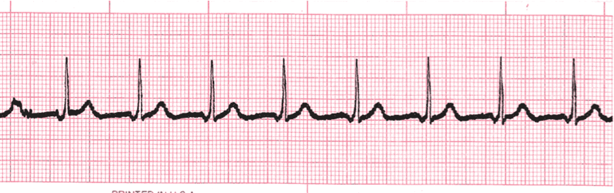 <p>HR: 60-100 bpm</p><p>P-wave: absent</p><p>Regularity: Regular</p><p>PR Interval: Absent</p><p>QRS Duration: Normal</p><p></p>