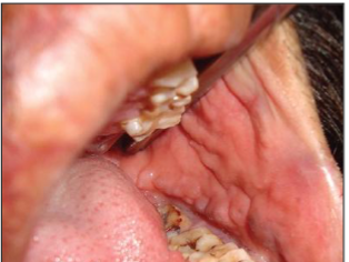<p>oral lesions with <strong>COBBLESTONE</strong> appearance </p>