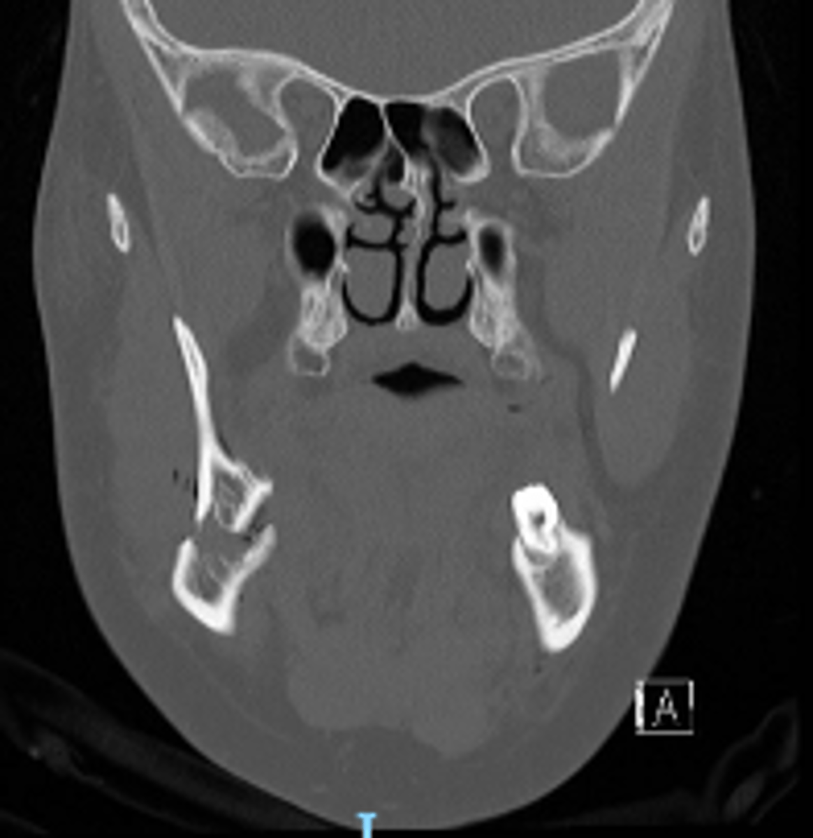 <p>ID the CT view:</p>