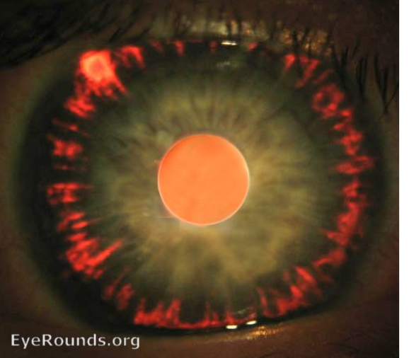 <p>what abnormality is visible in this picture </p>