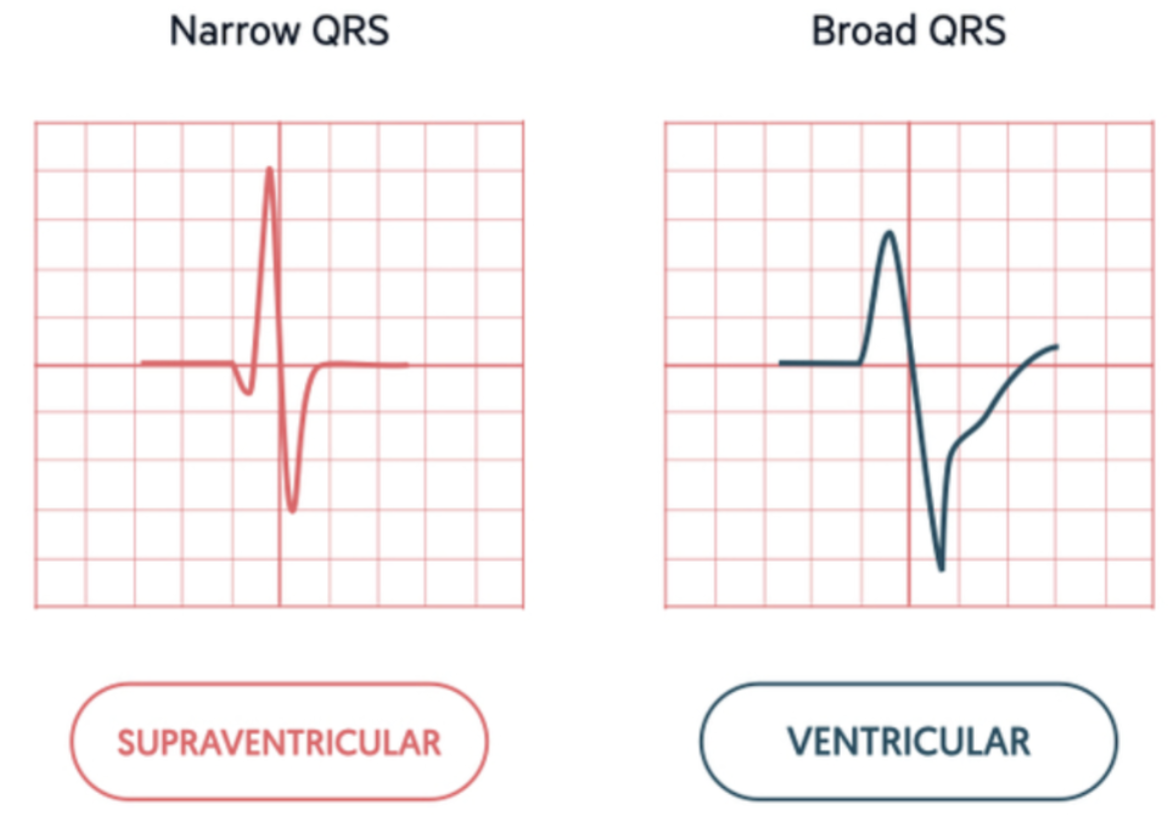 <p>A rhythm that <span style="color: purple;"><strong><mark data-color="purple" style="background-color: purple; color: inherit;">originates in the ventricles</mark></strong></span> will have a QRS measurement of 0.12 seconds or more&nbsp;</p>