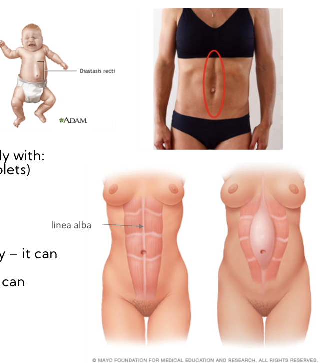 Separation of Fascia at Linea Alba (where the fascia layers fuse at the midline) 

* increases with abdominal straining 
* common during or following pregnancy 
  * carrying larger babies or multiples 
  * mom is of smaller structure 
  * age 35+
* Sometimes seen with newborns 

\
Treatment:

* stop all abdominal exercise during pregnancy - can worsen condition 
* Post -pregnancy - exercise & physiotherapy can improve function 
* sometimes surgery is needed