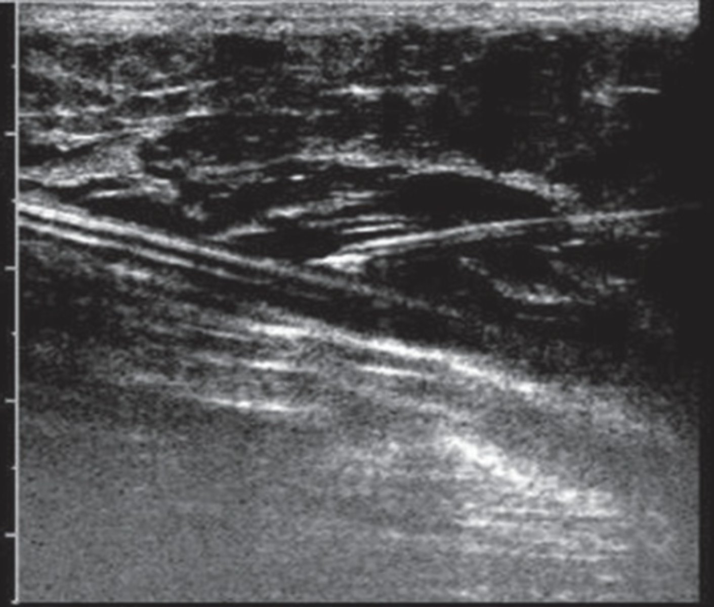 <p>Anesthetizes tissues</p><p>Prevents tissue/heat damage</p><p>Compresses vein - empties</p><p>Injected via ultrasound guidance</p>