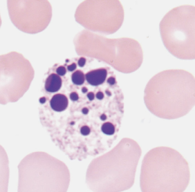 <p>what nuclear abnormality is associated with the following:</p><ul><li><p>dead cells</p></li><li><p>no filaments</p></li></ul><p></p>