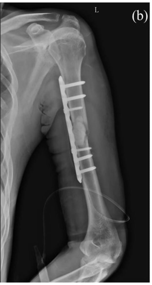<p>relatively large opening used to align metal plate with broken bone</p>