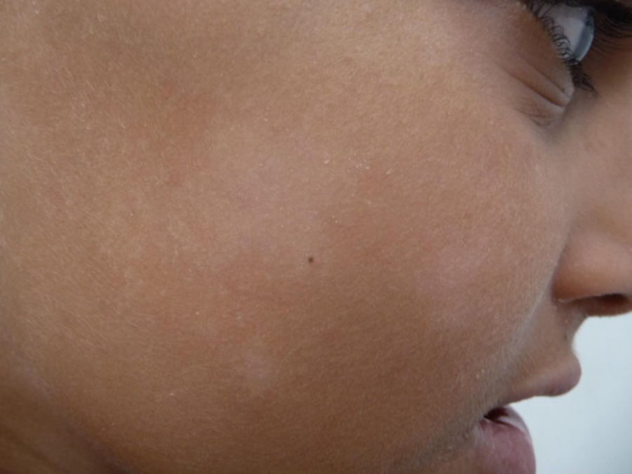 <p>what type of color change and condition is depicted</p>