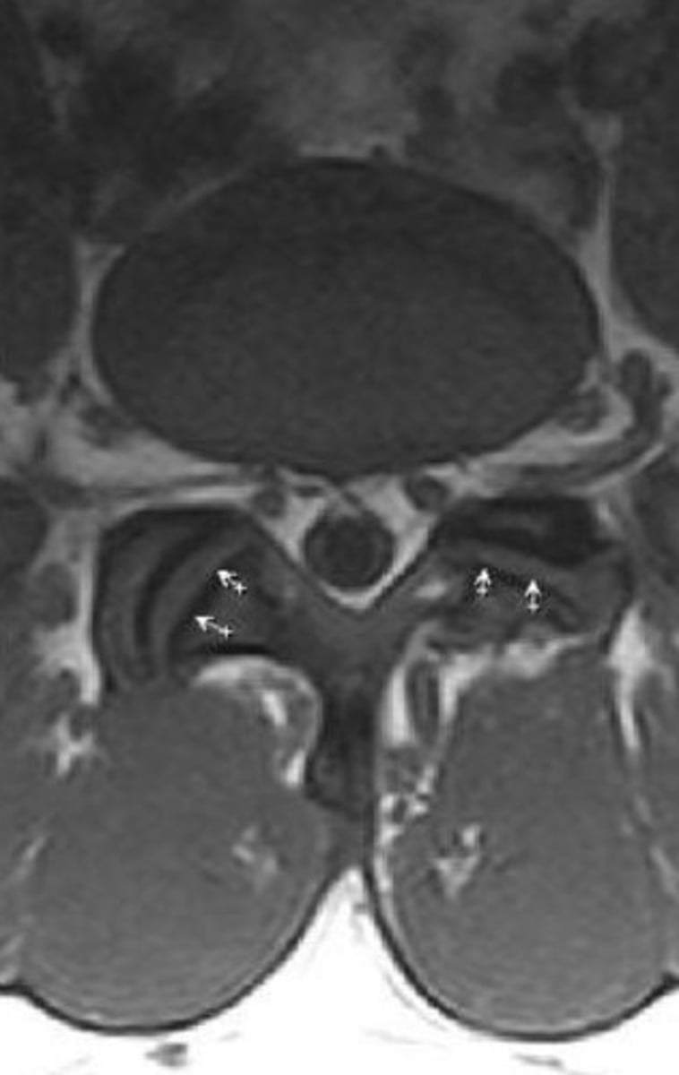 <p>CT studies</p><p>8 degrees or more difference = facet tropism</p>