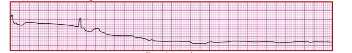 <p>Asystole</p>