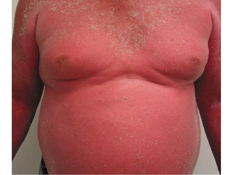 <p>which subtype of psoriasis?</p><ul><li><p>generalized erythema and exfoliation of ≥75% BSA</p></li><li><p>painful, pruritic scales</p></li><li><p>results from exacerbation of unstable plaque psoriasis</p></li><li><p>assoc w/ fevers, chills, malaise, arthralgias, LAD</p></li><li><p>leukocytosis w/ eosinophilia, anemia</p></li></ul><p></p>