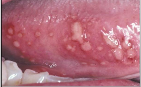 <p>Size: 1-3mm (small)</p><p>7-10 days of healing time</p><p>No scarring</p><p>Up to 100 lesions</p><p>Most recurrences</p><p>Least common</p>