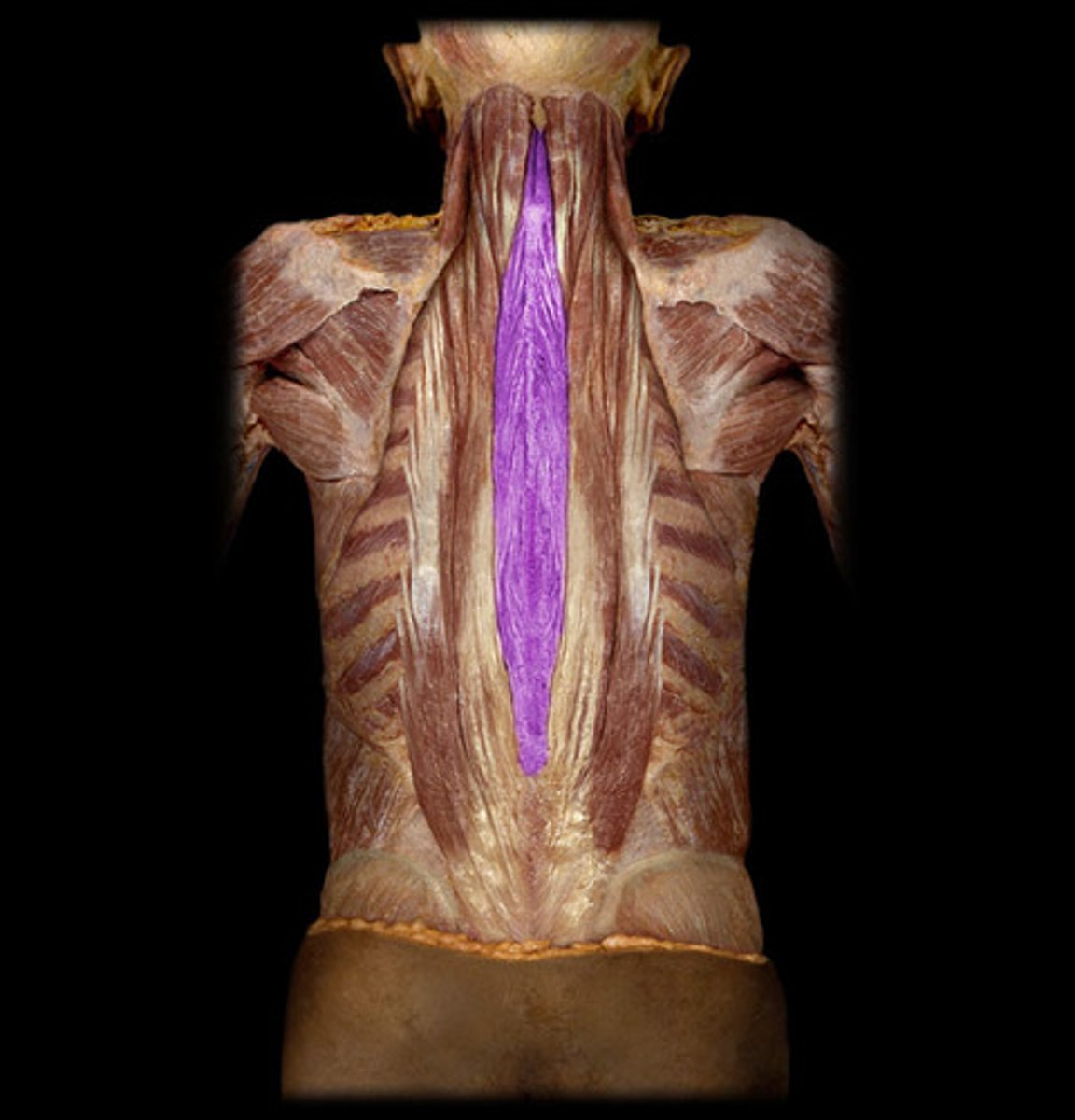 <p>Medial part of erector spinae, attaches to spinous processes</p>