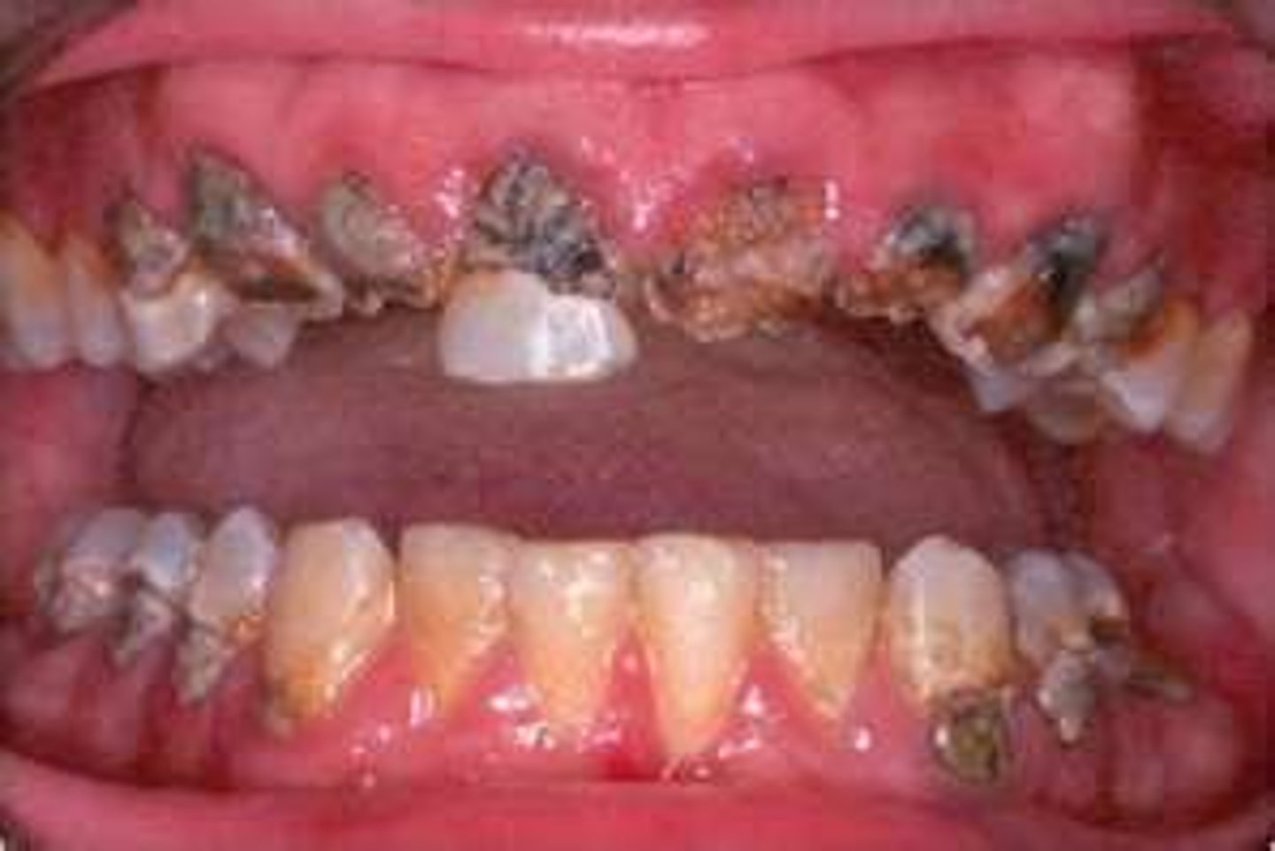 <p>enamel eroded away due to corrosive chemicals in product</p>