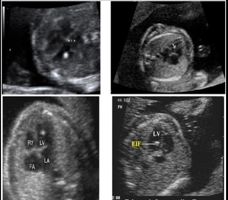 <p>while scanning the fetal heart in the 4 chamber view,</p><p>.</p><p>.you identify an <strong>echogenic focus </strong>near the apex of the l<strong>eft ventricle</strong> + two more along the <strong>ventricular septum</strong>. </p><p>.</p><p>these would cause the greatest increase in suspicion for what fetal syndrome</p><p>.</p><p>a) trisomy 21</p><p>b) trisomy 18</p><p>c) trisomy 13</p><p>d) turner syndrome</p>