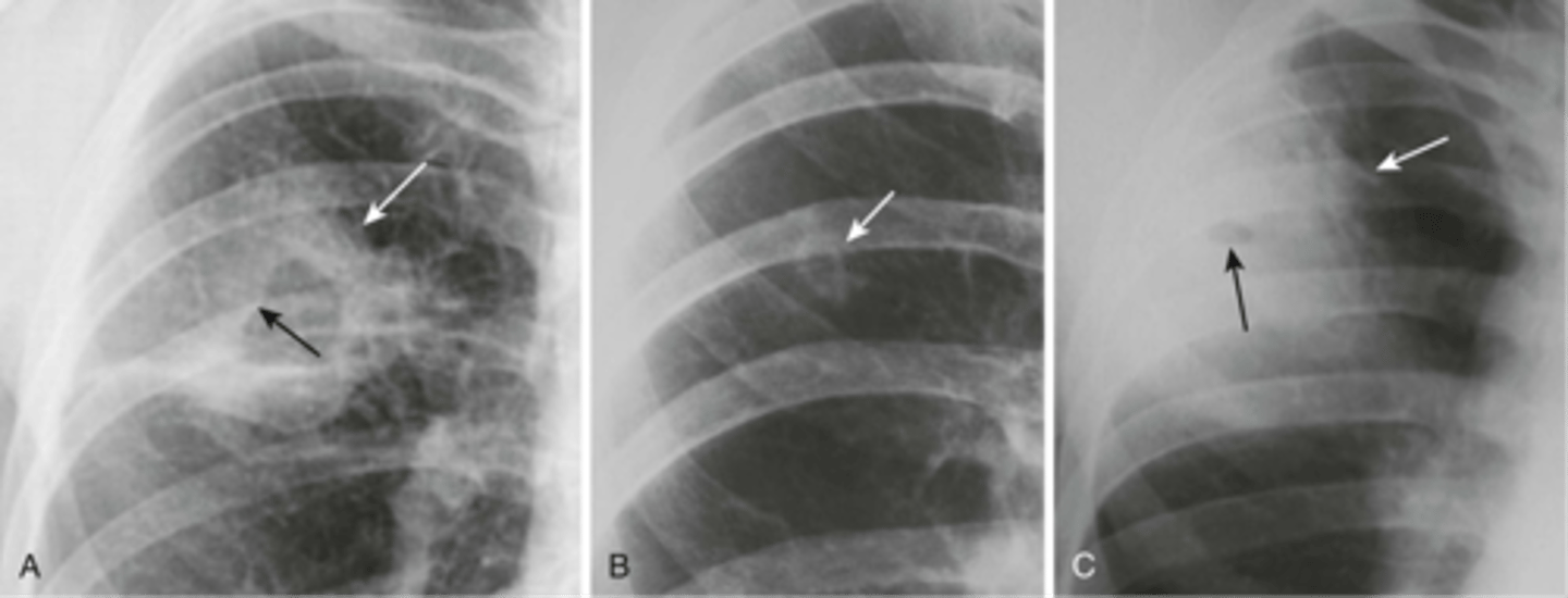<p>-thickest wall of the lesions (3mm-several cm)</p><p>-need to confirm with CT</p><p>-bronchogenic carcinoma, TB, lung abscess</p>