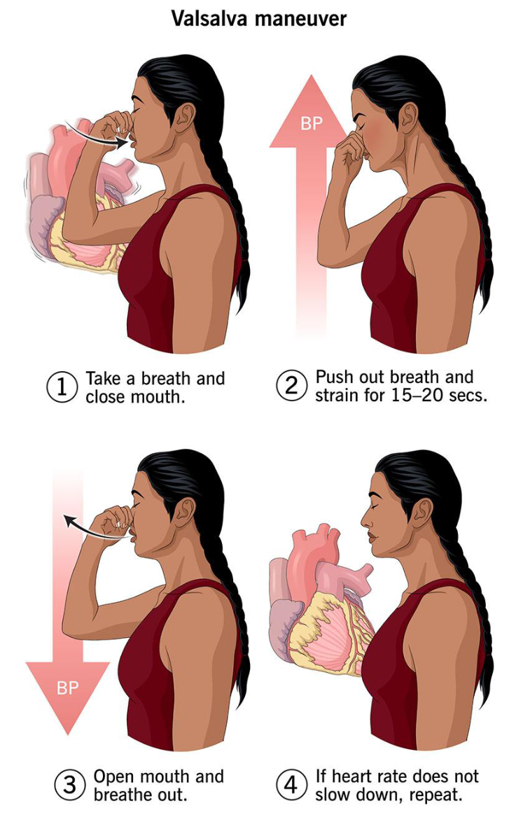 <ul><li><p><span><span>Resistance exercise (e.g. weightlifting) CAN cause dramatic increases in blood pressure - up to 345/245 mmHg! (not concerning since only happening for a short time)</span></span></p></li><li><p><span style="background-color: transparent;"><span>Due to the Valsalva maneuver, which increases intrathoracic pressure, temporarily raising BP and reducing venous return</span></span></p></li><li><p><span style="background-color: transparent;"><span>Holding the breath and straining during a lift, which increases intrathoracic pressure, transiently elevates blood pressure, and can slow heart rate</span></span></p></li></ul><p></p>