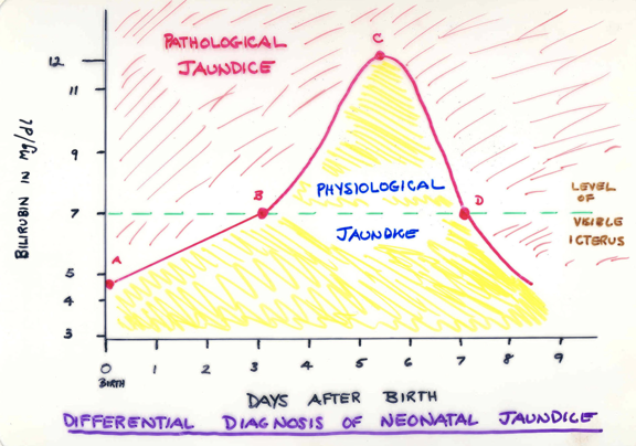 <p>In Neonates, when indirect bilirubin is unbound, it can cross blood-brain barrier and be absorbed into lipid-rich CNS neuron cell membranes.   </p><p>Forms pathological inclusions in neuron which interfere with myelination process.</p><p></p>