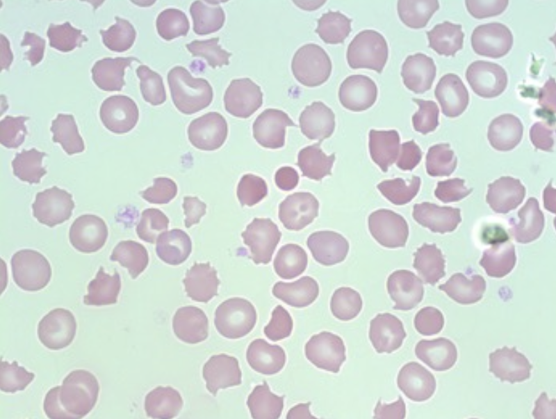 <p>What type of smear cell and what conditions is it seen in</p>