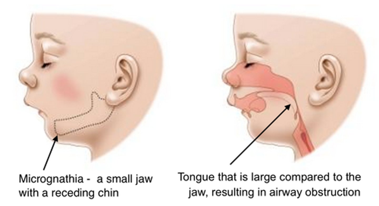 <p>Trisomy 13 &amp;18</p>