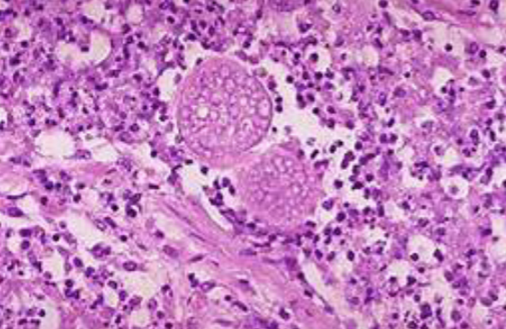 <p>In the San Joaquin Valley Area, patients have developed a wracking cough following a dust storm. Examination of fluid from lungs of patients shows the presence of spherules and fibrocaseous nodules.</p><p></p><p><strong>Proper name</strong> (Genus + specific epithet) of the organism responsible for patients’ illness?</p>