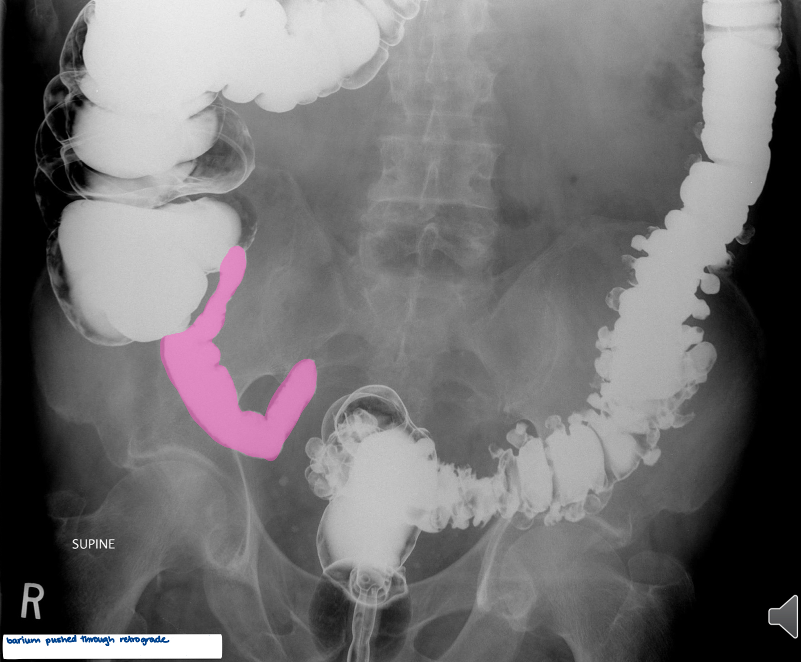 <p>What is the pink area?</p>