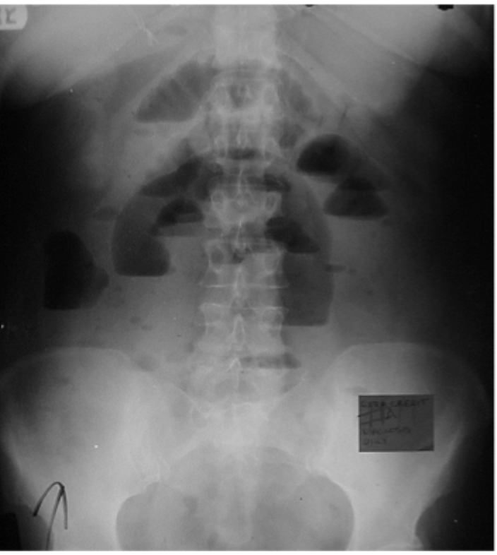 <p>Imaging findings of a mechanical SBO</p>