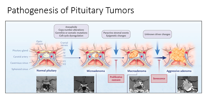 <p>Excessive hormone production by the pituitary gland is often caused by a noncancerous tumor (adenoma) that leads to the overproduction of one or more pituitary hormones.</p><p>Normal → Microadenoma → Macroadenoma → Aggressive Adenoma</p><p>Can get compression of the optic chiasm! Squeezed into the sella turcia! </p><p>The 2 types we will focus on:</p><ul><li><p><strong>Adenoma of Somatotropes (overproduce GH)</strong></p><ul><li><p>Treat via targeting IGF-1</p></li></ul></li><li><p><strong>Adenoma of Lactotrophs (overproduce Prolactin)</strong></p><ul><li><p>Treat via targeting Prolactin</p></li></ul></li></ul><p></p>