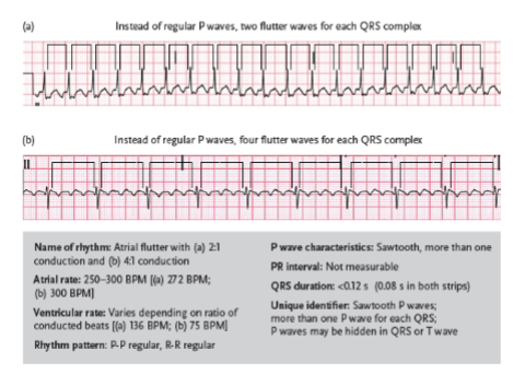 <p>an atrial rhythm that occurs when an irritable site in the atria fires at a very rapid rate</p>
