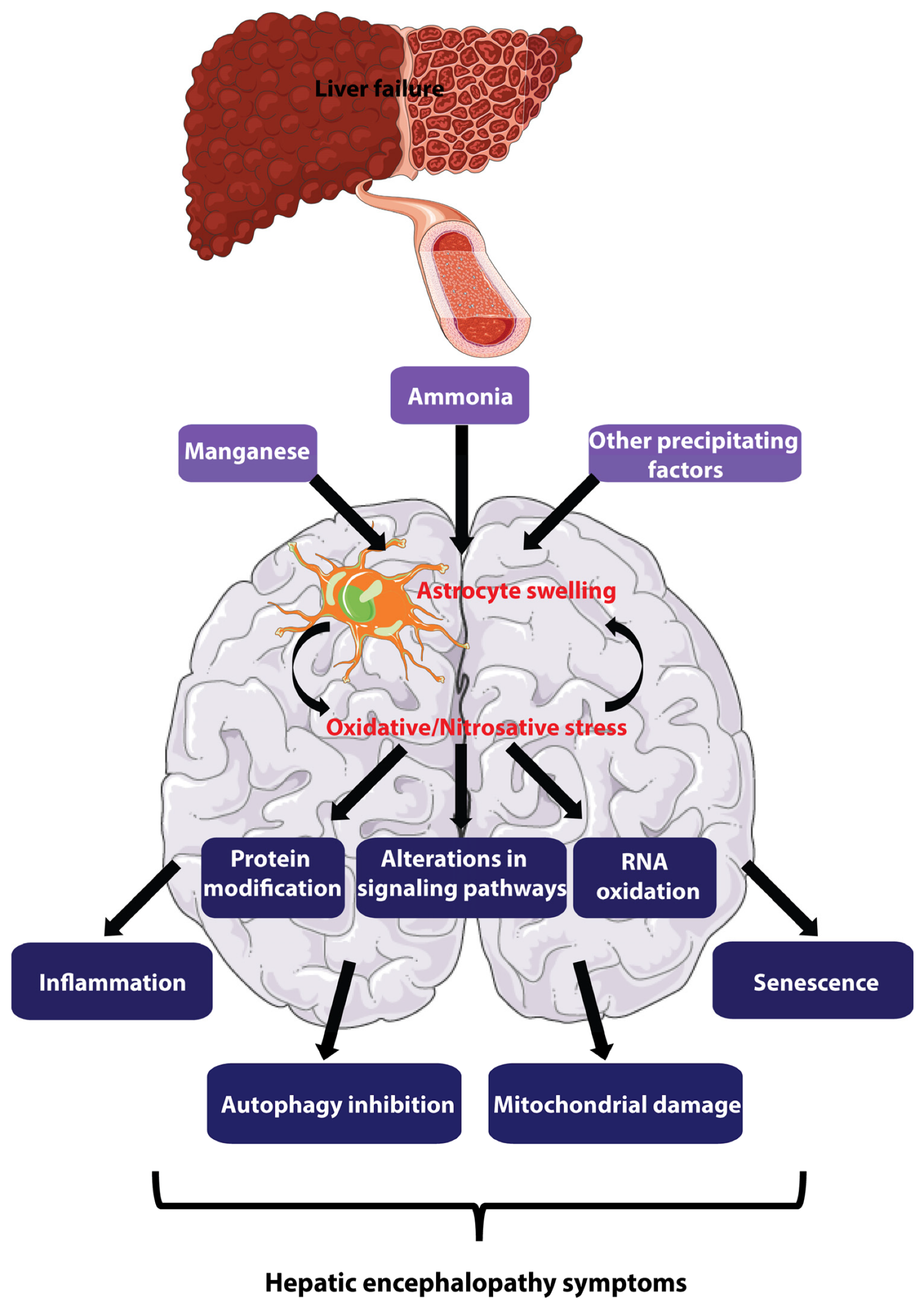 <ul><li><p>A neurological disorder caused by liver dysfunction, esp liver disease or liver failure. </p></li><li><p>liver is unable to adequately filter toxins (ammonia) from bloodstream.</p></li><li><p>toxins then accumulate and affect brain function, leading to a range of mental and physical symptoms.</p></li></ul><p></p>