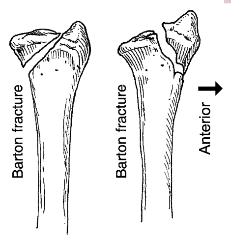 <p>Intra-articular fracture of the distal radius that often involves subluxation or dislocation of the radiocarpal joint anterior or posterior</p>