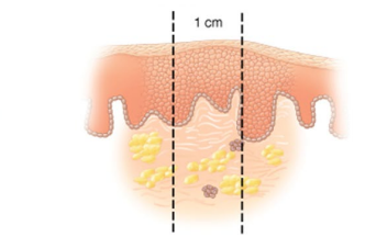 <p>What type of skin lesion is this?</p>