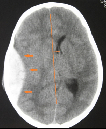 <p>Bleeding inside the brain; a medical emergency.</p>