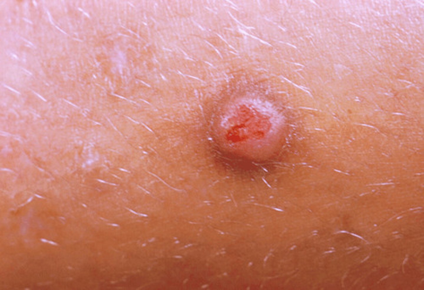 <p>a solid elevation of less than 1 cm in diameter and has distinct borders</p><p>ex. small, raised pimple</p>
