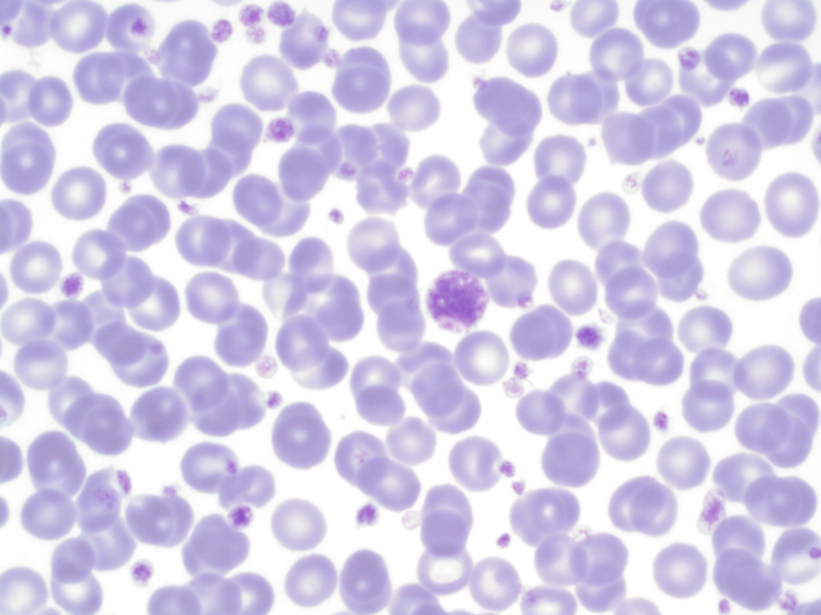 <p>what disease/condition is associated with normal RBC morphology and elevated platelet count?</p>