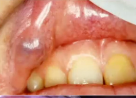 <p>most likely diagnosis of this benign lesion </p>