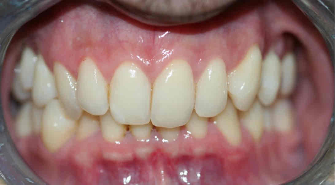 <p>esthetic of the mandibular incisors </p>