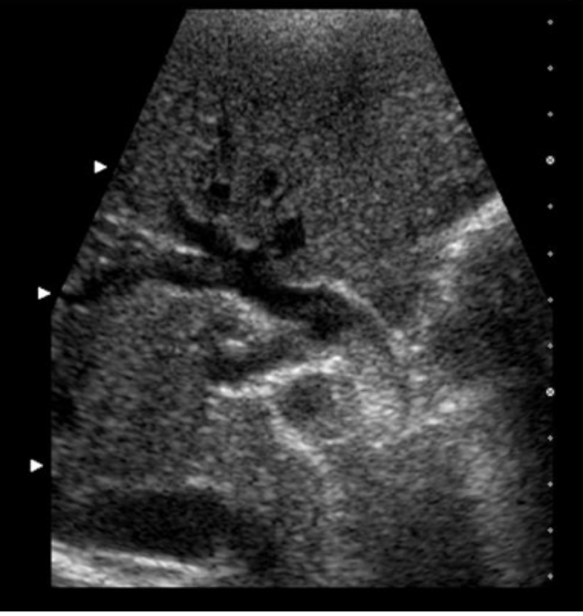 <p>You have obtained this image from the RUQ of a patient with abdominal pain, nausea, and vomiting. What pathology is present?</p><p>a. gallstones</p><p>b. dilated common bile duct</p><p>c. portal vein thrombosis</p><p>d. pneumobilia</p><p>e. pancreatic pseudocyst</p>