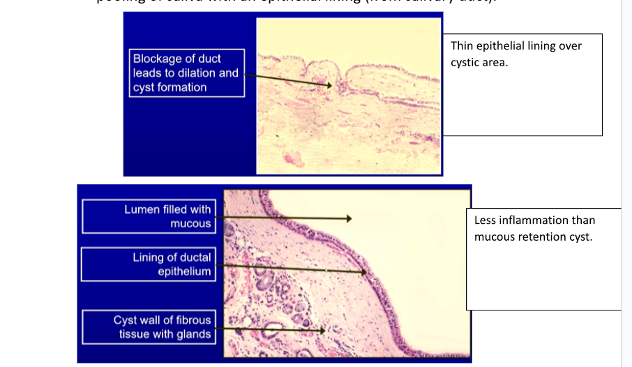 <p>Who → older age groups 40+</p><p>Where → FOM, buccal mucosa</p><p>Blocked duct → no rupture → saliva produced → duct expands → pooling of saliva with epithelial lining from duct</p>