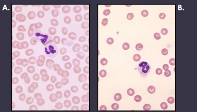 <p>What patient (A or B) would be anemic and why?</p>