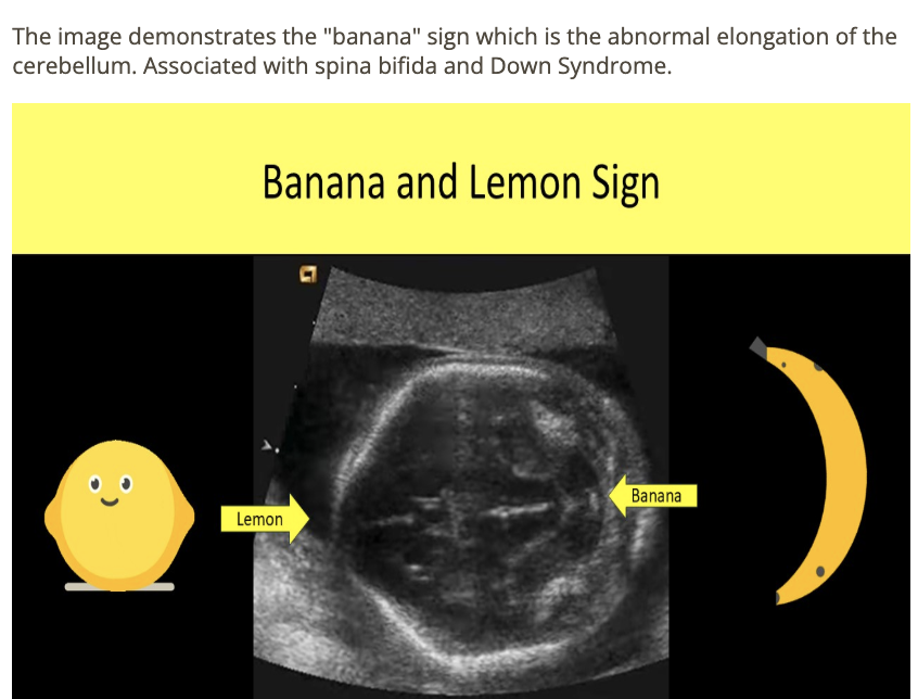 <p>b) banana sign</p>