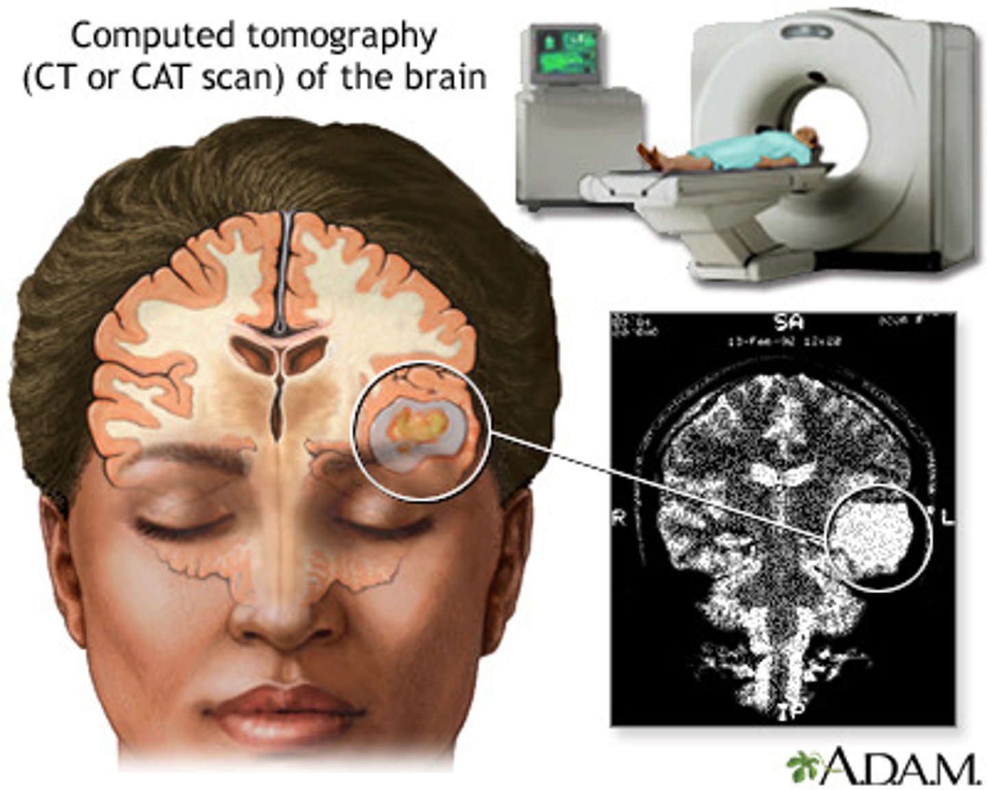<p>(C) CT Scans</p><p>CT Scans use X-rays to create a detailed image of the brain.</p>