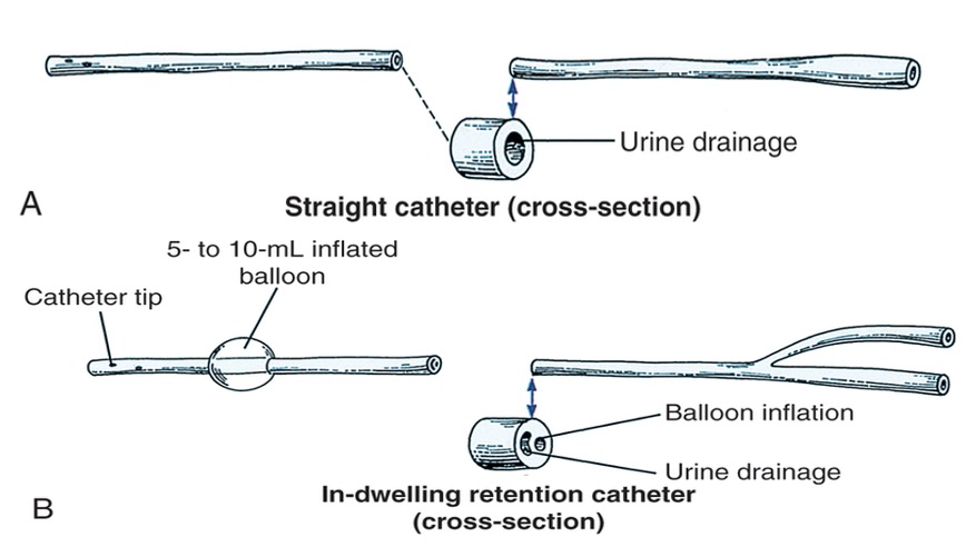 <p>Straight Catheter</p><ul><li><p>Single lumen with small open.</p></li><li><p>Urine drains from the tip, through the lumen and into the receptacle.</p></li><li><p>Can be performed by the patient.</p></li><li><p>Common in patient who have incomplete bladder emptying:</p><ul><li><p>Neurogenic conditions</p></li><li><p>Post anesthetic</p></li><li><p>Post-op certain urinary surgeries or vaginal hysterectomy</p></li></ul></li><li><p>To obtain sterile sample “in and out”</p></li></ul><p>Indwelling or “Foley” Catheter</p><ul><li><p>Retained for longer periods of time.</p></li><li><p>Retained by small balloon which anchors it against the bladder neck.</p></li></ul><p>Coude Tip</p><ul><li><p>Male patient with an enlarged prostate which obstructs the urethra.</p></li><li><p>Less traumatic during insertion.</p></li><li><p>Stiffer and easier to control.</p></li></ul><p></p>
