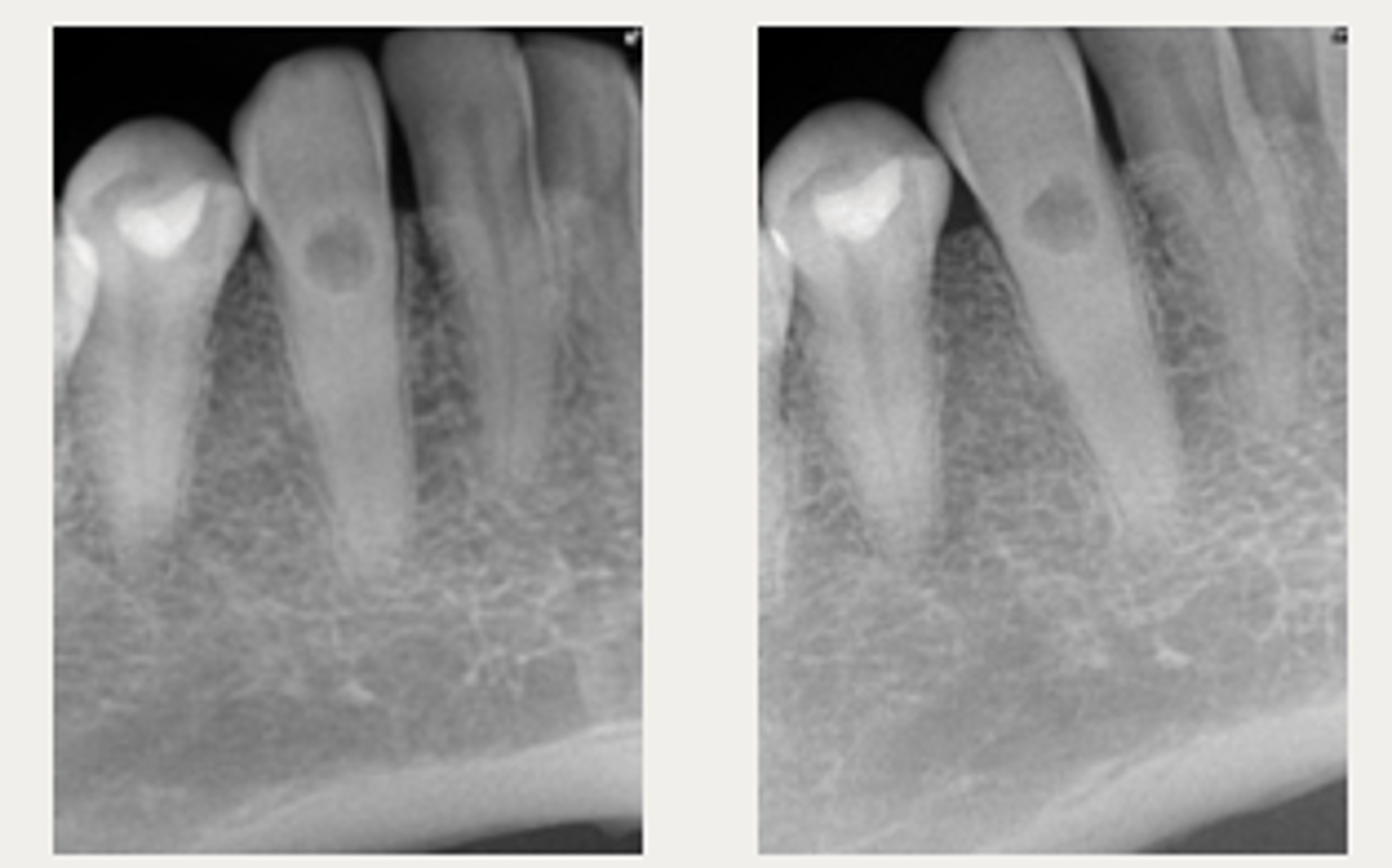 <p>Patient presents with symmetrical ballooning of the root canal and lesion does not move when PA is taken from different angles. There is no PARL. What is the most likely diagnosis? </p>