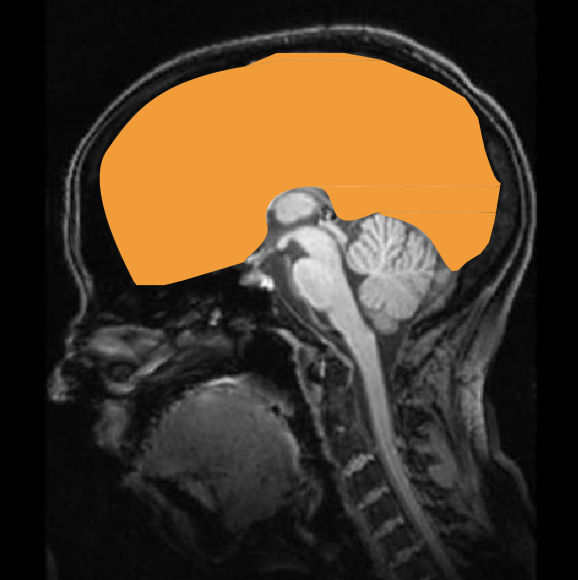 <p>largest and most sophisticated division of brain - cortex and underlying structures</p><ul><li><p>cerebral cortex</p></li><li><p>convolutions</p></li><li><p>cerebrum hemispheres</p></li><li><p>commissures</p></li><li><p>limbic system</p></li><li><p>basal ganglia</p></li></ul><p></p>