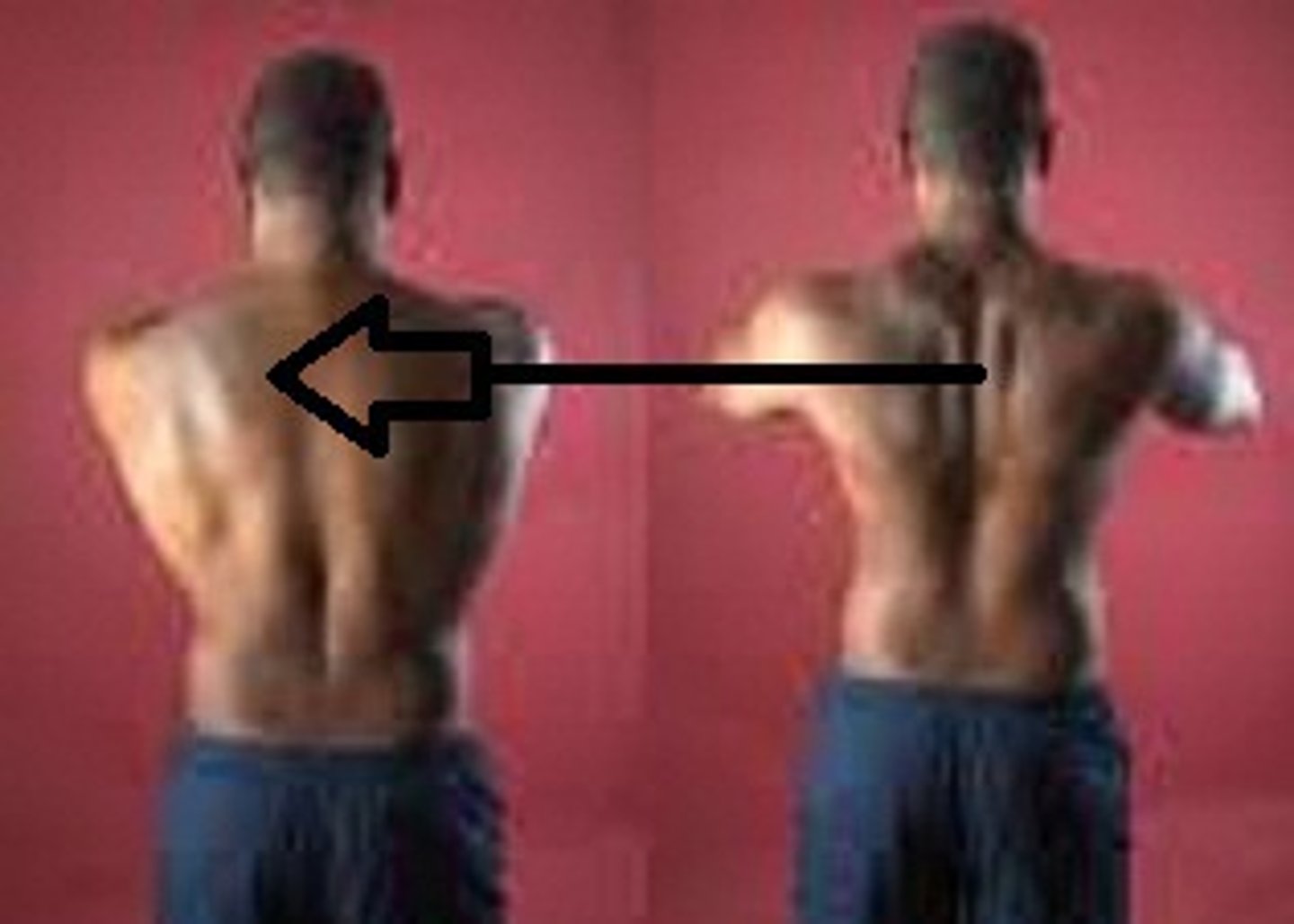 <p>Adduction of scapula; shoulder blades move toward midline. (pictured on the right)</p>
