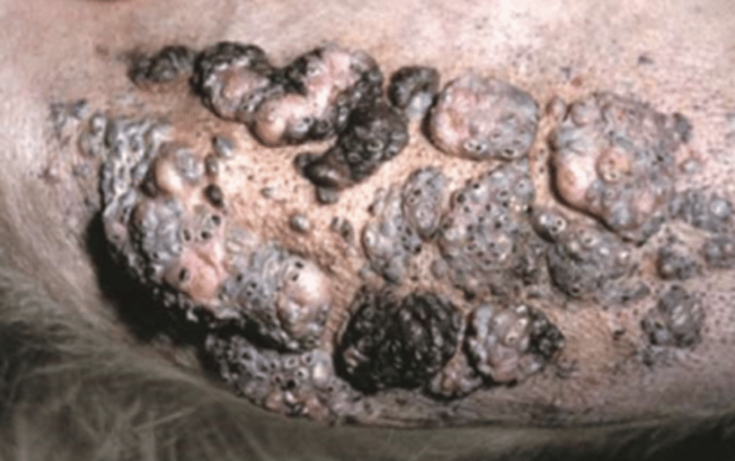 <p>¿lesión?</p><p>¿primaria o secundaria?</p>