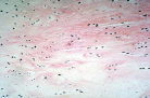 Location: Intervertebral discs, symphysis pubis, menisci of the knee
Structure:  parallel rows of chondrocytes appear farther apart and in between is extracellular matrix filled with thick collagen fibers.
Function: withstand heavy pressure, compression, shock absorption